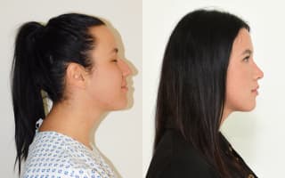 Nose surgery