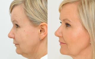 Double chin liposuction