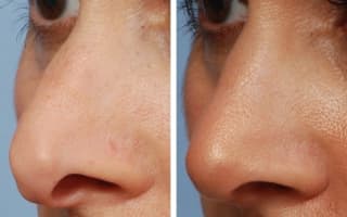 Nose surgery