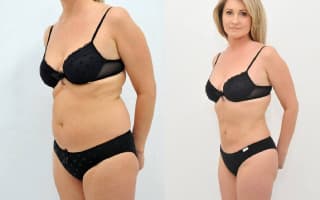 Lipotransfer