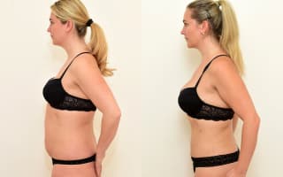 Lipotransfer