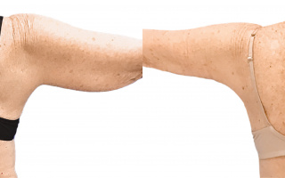 Lipotransfer
