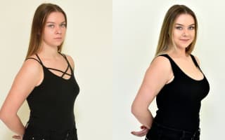Breast enlargement