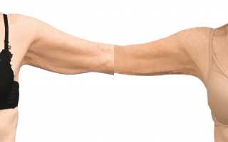 Lipotransfer