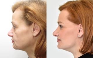 Facelift