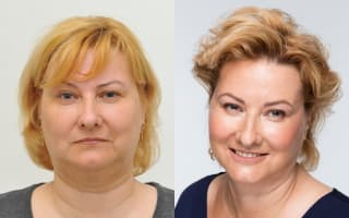 Double chin liposuction