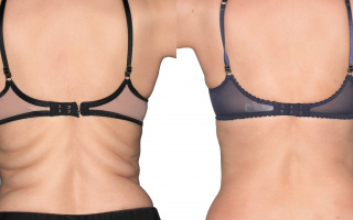 Lipotransfer