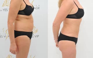 Lipotransfer