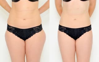 Lipotransfer