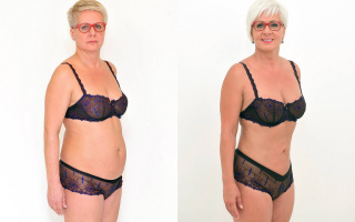 Lipotransfer