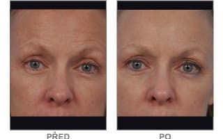 Brow and eyebrows