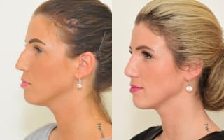 Nose surgery