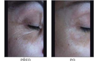 Brow and eyebrows