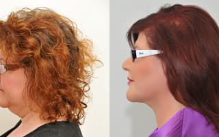 Lipotransfer
