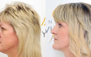 Eyelids surgery