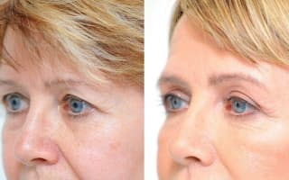 Eyelids surgery