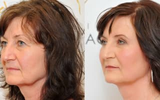 Eyelids surgery