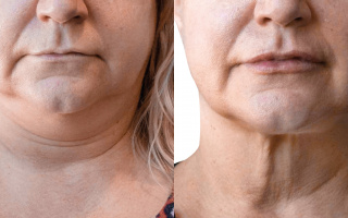 Lipotransfer