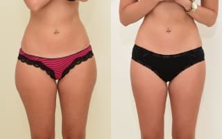 Lipotransfer