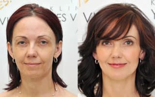 Eyelids surgery