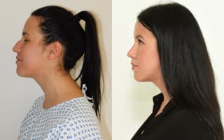 Nose surgery