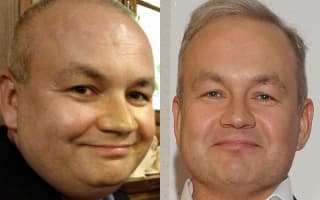 Double chin liposuction