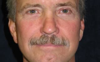 Nose surgery