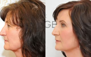 Eyelids surgery