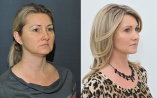 Brow and eyebrows