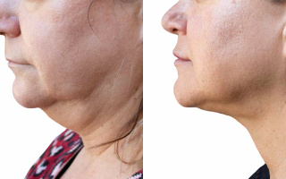 Lipotransfer