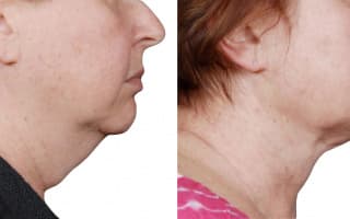 Lipotransfer