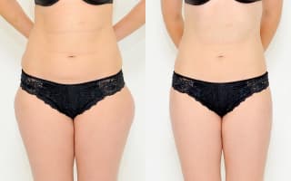 Lipotransfer