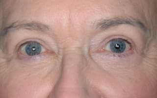 Bags and circles under the eyes