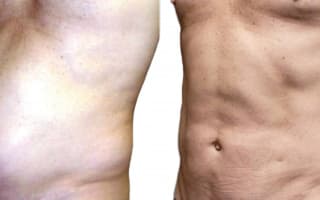 Lipotransfer