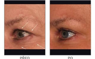 Brow and eyebrows