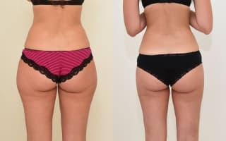 Lipotransfer