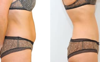 Lipotransfer