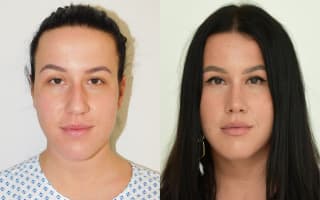 Nose surgery