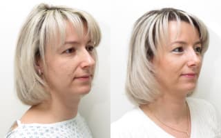 Nose surgery