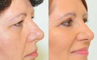 Eyelids surgery