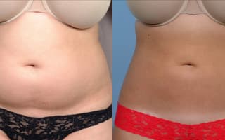 Lipotransfer