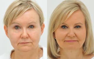 Double chin liposuction