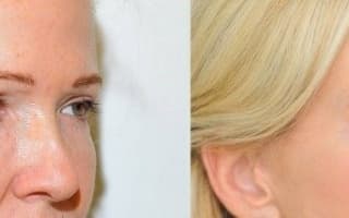 Eyelids surgery