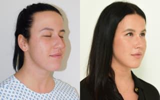 Nose surgery