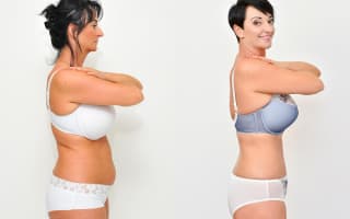 Lipotransfer