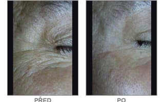 Brow and eyebrows