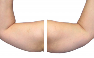 Lipotransfer
