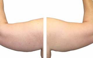 Lipotransfer