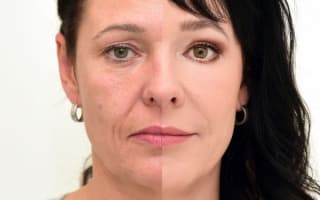 Eyelids surgery