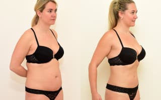 Lipotransfer